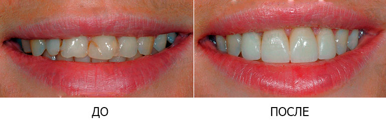 bezmetallovaya keramika