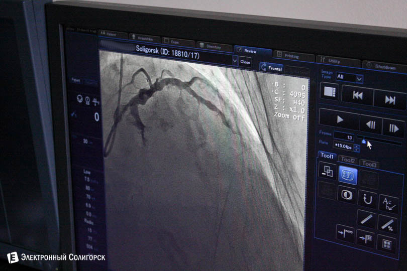 snimok angiograf soligorsk