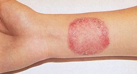 дермотомикоз2