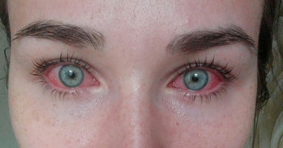 ресницы коньюктивит